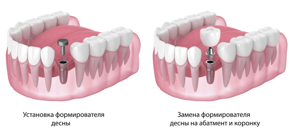 Формирователь десны